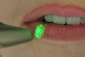 Pomlajevanje ustnic z laserjem – LipLase