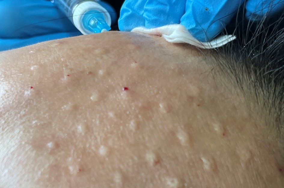 Aplikacija skinboosterjev z mikroinjekcijami