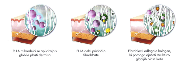 Shema delovanja biostimulatorja Sculptra